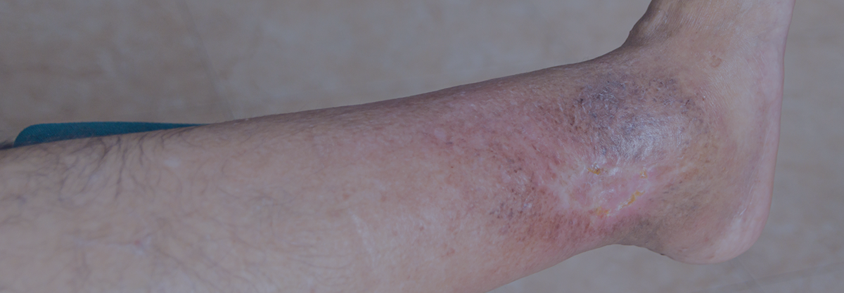 leg ulcer